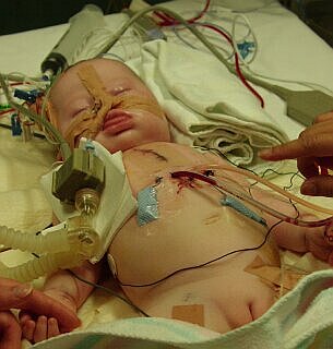 Grace shortly after surgery